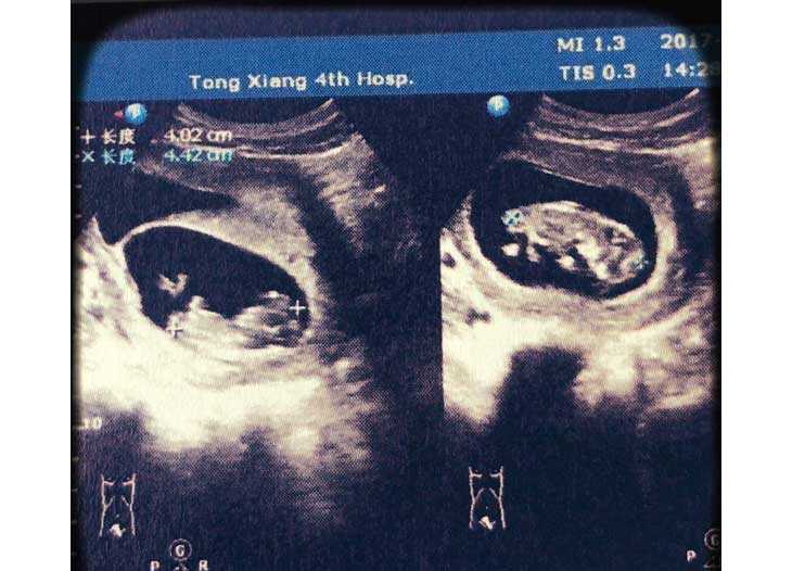 怀孕八周香港验血正确不,【武汉供卵试管包成功有吗】多囊卵巢备孕8个月，终